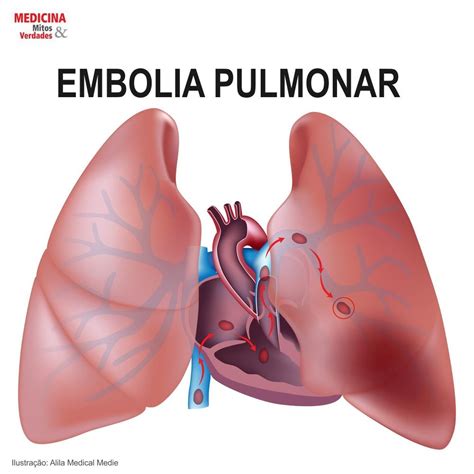 Embolia Pulmonar Causas Sintomas E Consequ Ncias Medicina Mitos E Verdades