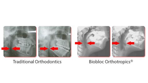 What Is Orthotropics Naafo