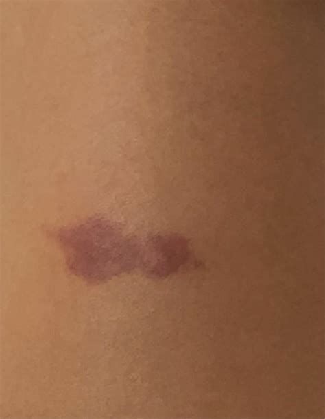Do Anyone Mosquito Bites Get Dark Red Like This 5 Day Old Bites R