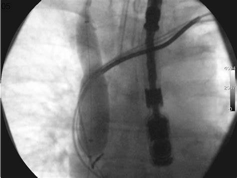 Balloon Assisted Rescue Of Four Consecutive Patients With Vascular