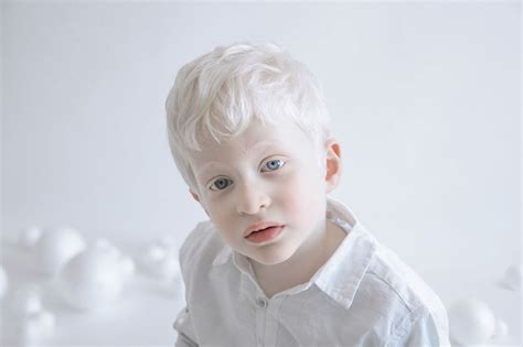 These 13 Photos Perfectly Capture The Beauty Of People With Albinism