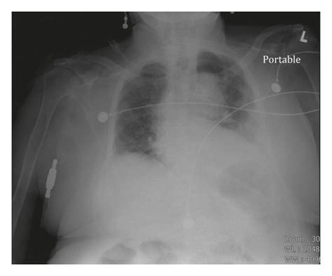 Chest X Ray Obtained On Admission Showing Left Lower Lung Infiltrate