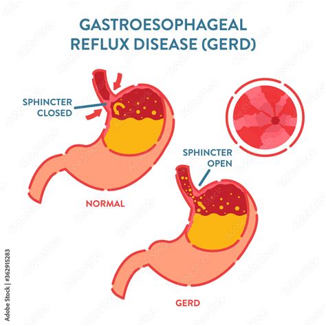 Gastroesophageal Reflux Disease Diagnostics Poster Endoscopic Image Of