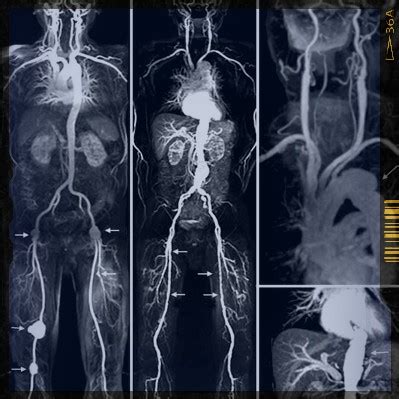 6.13 ct angiography of the right upper limb: CTA vs MRA - Angiography - RadTechOnDuty