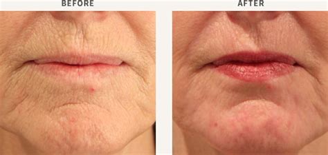 Laser Resurfacing Wrinkles Sydney Dermatology Group