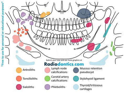 Panoramic Radiopacities Radiodontics