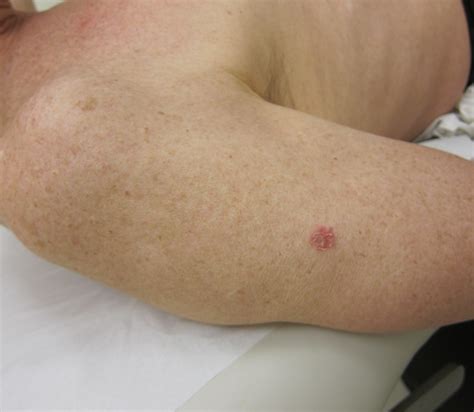 Dr Pat Consults When Is Laser Treatment The Best Option For Skin