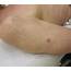 When Is Laser Treatment The Best Option For Skin Cancer  Womens