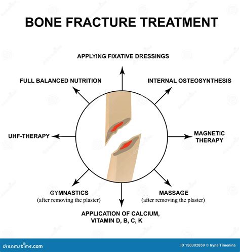 Treatment Of Bone Fractures Bone Fracture With Displacement