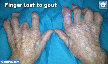 An attack of gout can occur suddenly, often waking you up in the middle of the night with the. Finger Lost To Gout | GoutPal Gout Facts
