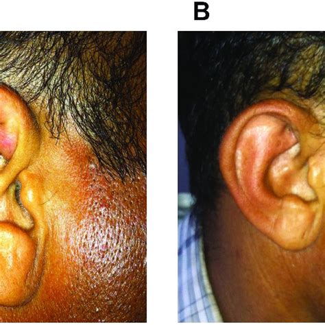 Pdf Treatment Of Auricular Pseudocyst With Intralesional Steroid A