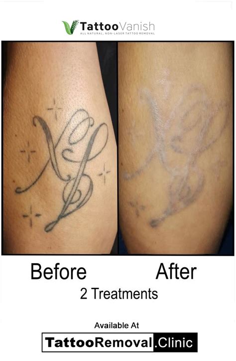 Torontos Premier Non Laser Tattoo Removal Clinic