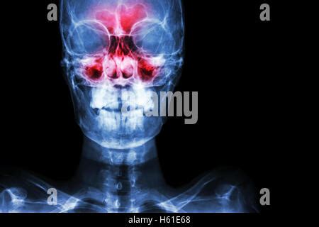 Sinusitis Film X Ray Skull Ap Anterior Posterior Show Infection And Inflammation At