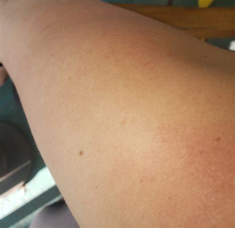 Pmle Sun Allergy Rash Pictures Life Without Dressing