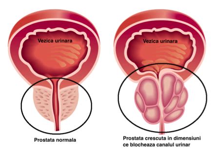 Hipertrofie Prostatica Obstructie Dr Marcel Rad