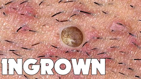 Ingrown armpit hair, lymph node, pictures, lump, how to. Ingrown Hair Removal! What is Ingrown Hair? - YouTube
