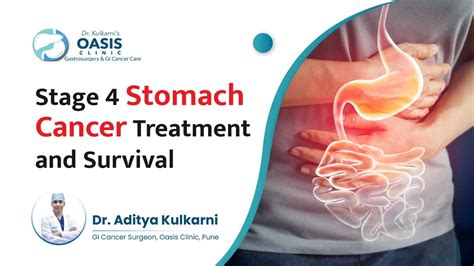 Stage 4 Stomach Cancer Treatment And Survival