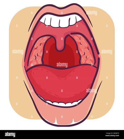 Swollen Tonsils Hi Res Stock Photography And Images Alamy