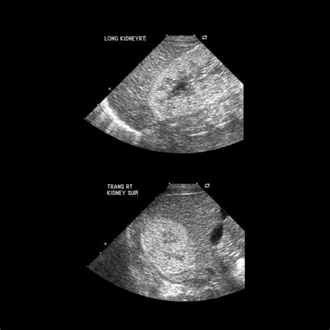 Newborn With Echogenic Kidneys On Prenatal Ultrasound Pediatric