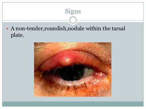 Eyelid Cysts