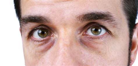 Dark Circles Under The Eyes Why We Have Them And How To Treat Them