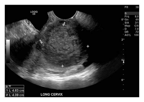 A Transvaginal Ultrasound The Gray Scale A And Color Doppler Images