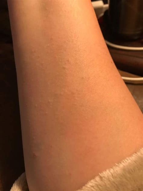 Itchy Bumpsrash On Arm Accutane Isotretinoin Logs By Accutanefl