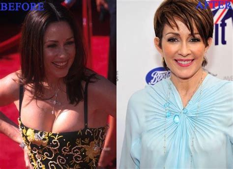 Patricia Heaton Breast Reduction Before And After Photo Patricia Heaton