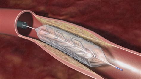 Real Men Wear Gowns Heart Stents Can Prevent Serious Health Problems