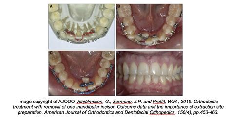 Lower Incisor Extraction In Orthodontics Dastardly Or Excellence