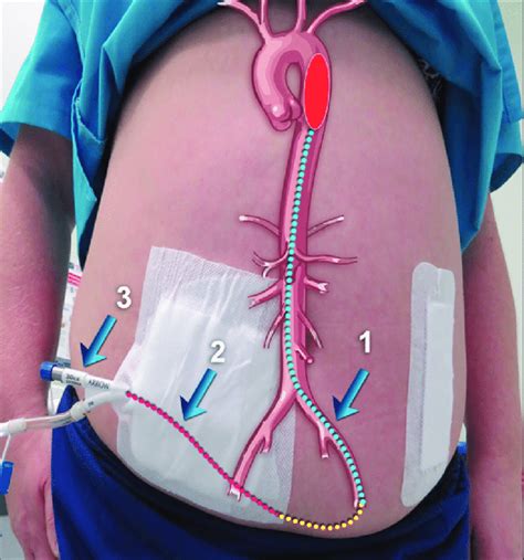 Intra Aortic Balloon Pump Heart