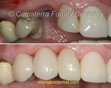 Dental Bridges Missing Teeth Dentist Orange Milford Ct