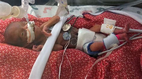 Premature Baby Born At 22 Weeks Is One Of The Youngest Ever To Survive