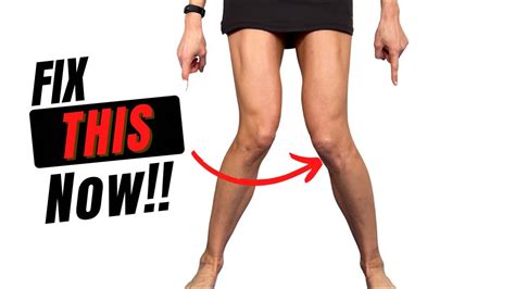How To Fix Knock Knees With Exercise Youtube