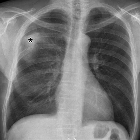 Chest Radiography In Thoracic Polytrauma Ajr