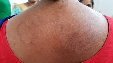 Epedemic Skin Disease Attacks Mahendraganj Area Of Garo Hills Assam Times