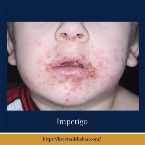 Impetigo Causes Symptoms And Treatment Kreetan Khabar 2023