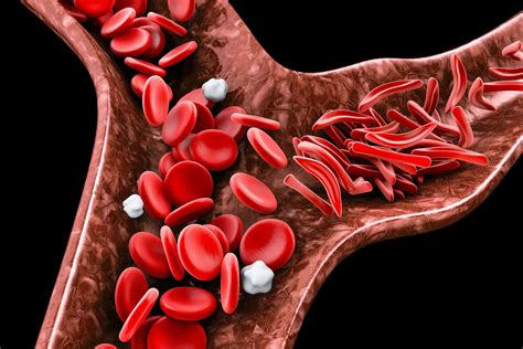 Dia Mundial De Conscientização Da Anemia Falciforme Spsp