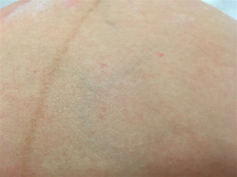Weird Red Dots On Me Babycentre