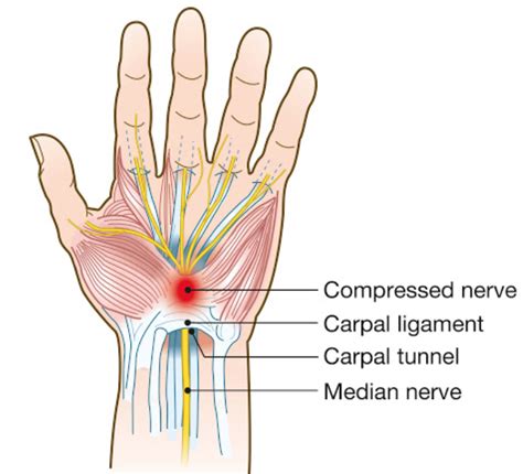 How An Early Case Of Carpal Tunnel Syndrome Could Have Prevented More