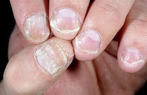 The Nuisance Of Nail Psoriasis Nail Psoriasis Nails