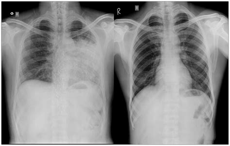 Icd Normal Chest X Ray For Tuberculosis My Xxx Hot Girl