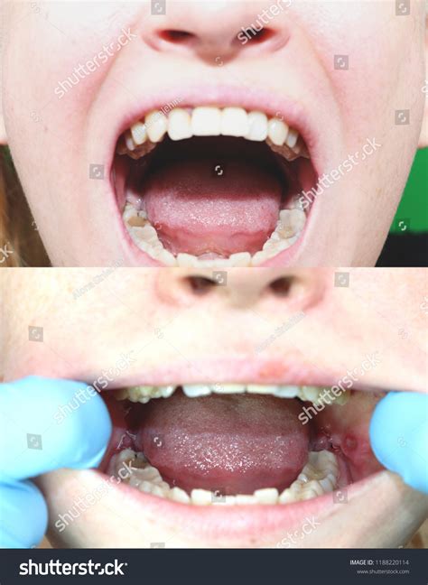 26 Stitches After Dental Extraction Images Stock Photos And Vectors