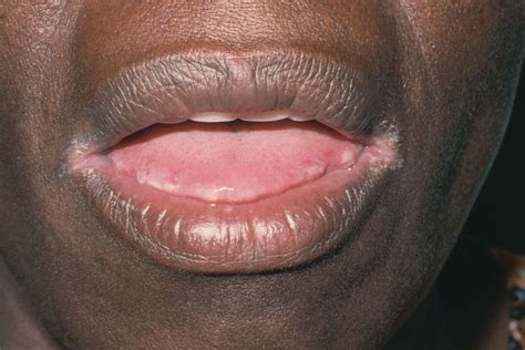 Fungal Infection On Lips Symptoms