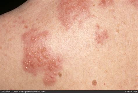 Stock Image Infectious Diseases Shingles Herpes Zoster Clusters Of