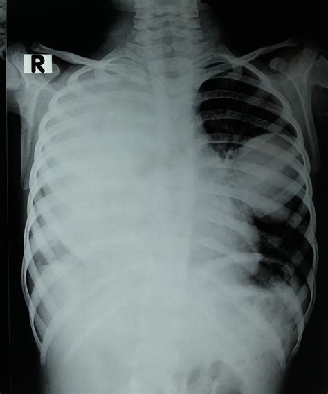 A Case Of Multiple Giant Primary Bilateral Lung Hydatid Cysts In A Very