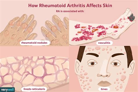 What Skin Problems Does Rheumatoid Arthritis Cause