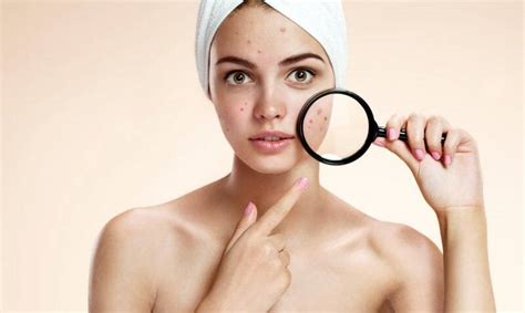 Pimple Scar Removal And Laser Treatments For Acne Scars In Singapore