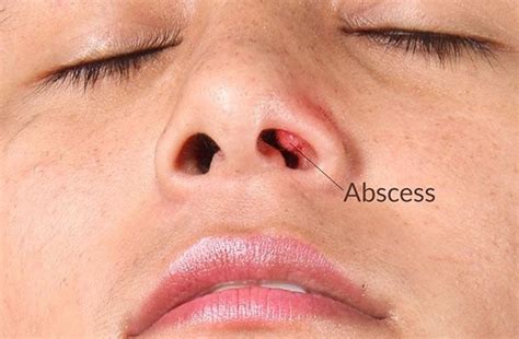 Causes Of Abscess Inside Nose Healthremedy Easy Health Remedy