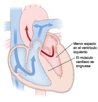 Puente miocárdico en paciente con miocardiopatía hipertrófica diagnosticado por tomografía multicort. Krames Online - Si su hijo tiene miocardiopatía hipertrófica